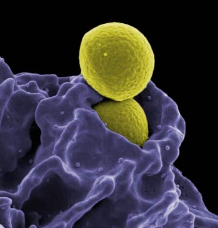 Methicillin resistant staphylococcus aureus mrsa