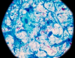 Η πρωτεΐνη Tat του HIV αυξάνει την ευαισθησία στην φυματίωση