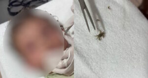 Καβούρι εισέβαλε στο αυτί αγοριού στο Μεξικό
