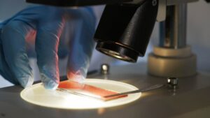 Χιλιάδες Βρετανοί υποφέρουν από αναιμία χωρίς να το γνωρίζουν