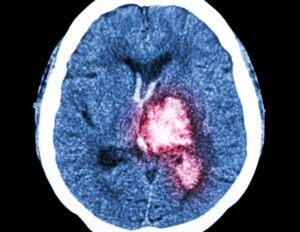 Υποσχόμενη θεραπεία για κληρονομική αιμορραγική διαταραχή με το φάρμακο engasertib