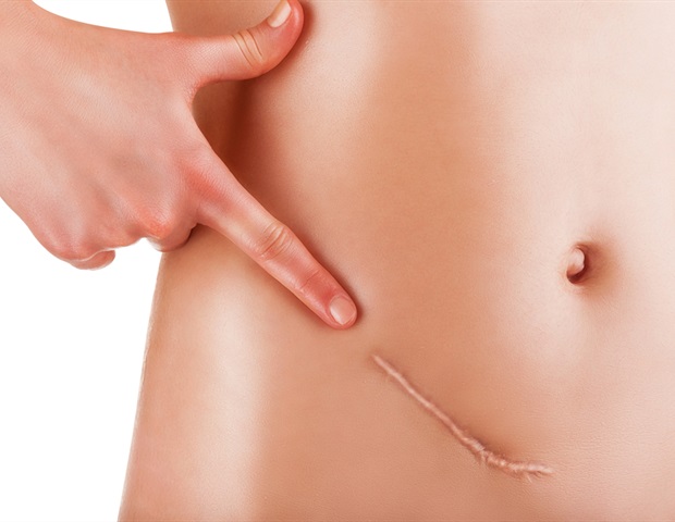 Νέα εξέλιξη στη θεραπεία του καρκίνου των ωοθηκών με απλή αιματολογική εξέταση