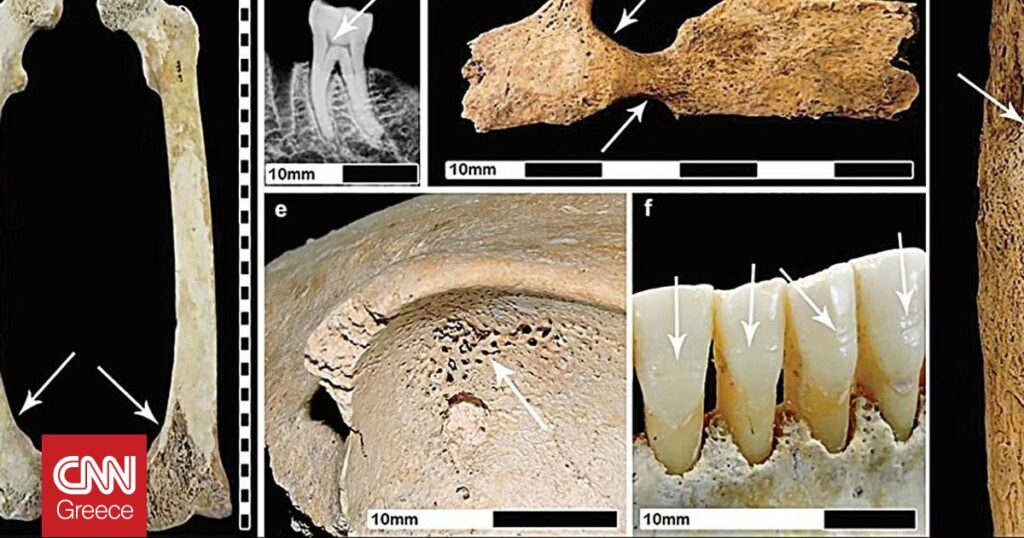 Οι αρχαίοι Ρωμαίοι επηρέασαν αρνητικά την υγεία των Βρετανών