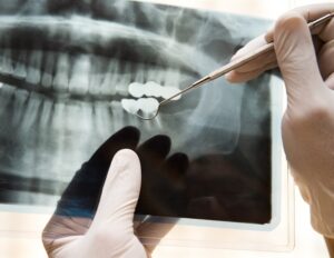 Αυτοματοποιημένο σύστημα βελτιώνει την ακρίβεια της ανάλυσης θωρακικών ακτινογραφιών