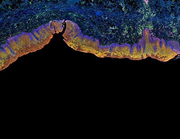 Η κατανόηση της αναστολής της νευρογένεσης από το σεβοφλουράνιο στα παιδιά