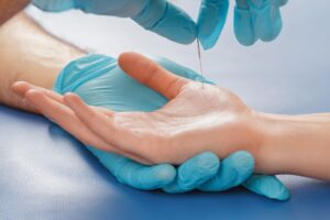 Η βελονισμός μπορεί να επιταχύνει την ανάρρωση ασθενών σε ΜΕΘ