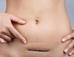 Σύνδεση ανώμαλου κολλαγόνου σε ουλές μήτρας με ανάπτυξη πλακούντα ακρέτα