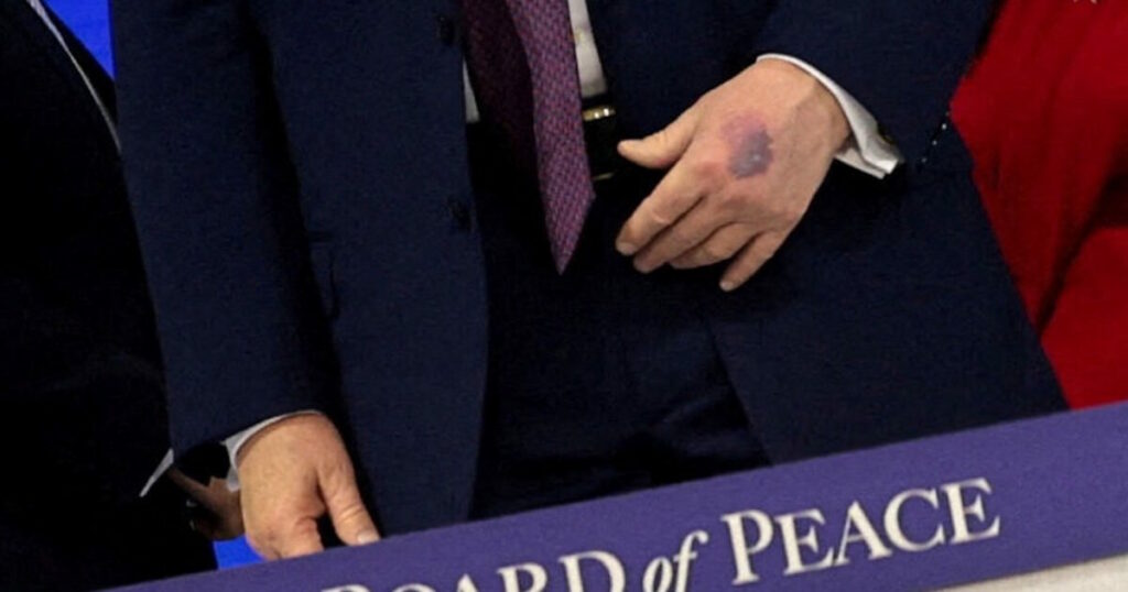 Η εξήγηση του Ντόναλντ Τραμπ για τη μελανιά στο χέρι του