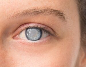 Μελέτη εξετάζει τη σχέση μεταξύ μήκους τελομερών και καταρράκτη σχετιζόμενου με την ηλικία