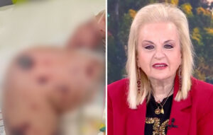 Παγώνη: Δεν έχουμε θανάτους από ιογενή μηνιγγίτιδα στη Ζάκυνθο