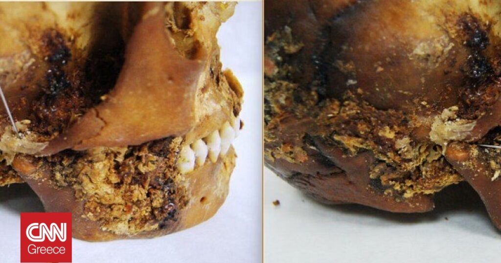 Ανακαλύψεις 2.500 ετών: Γυναίκα επιβίωσε από πρωτοποριακή χειρουργική επέμβαση