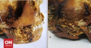 Ανακαλύψεις 2.500 ετών: Γυναίκα επιβίωσε από πρωτοποριακή χειρουργική επέμβαση