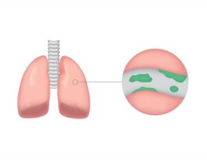 New initiative tackles bronchiectasis underdiagnosis in the U.S.