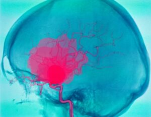 Φάρμακα για την οστεοπόρωση μπορεί να επιβραδύνουν την εξέλιξη ανευρυσμάτων