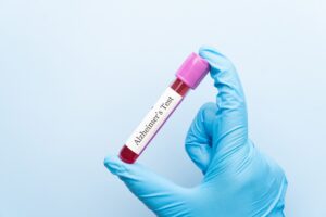 Καθοριστικές ηλικίες για την αλλαγή των βιοδεικτών της Alzheimer